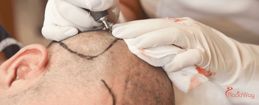 DHI Hair Transplant in Turkey