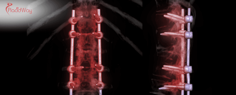 Spinal Fusion Surgery in Turkey