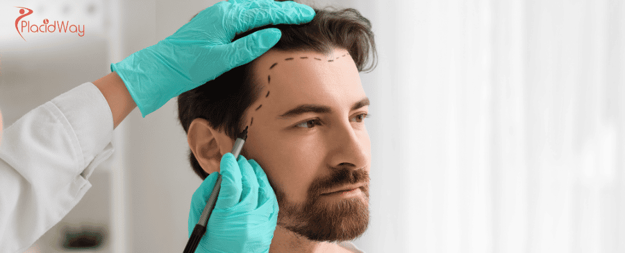 Hair Transplant in Turkey
