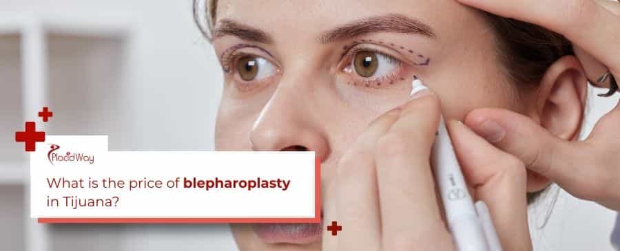 Blefaroplastia
