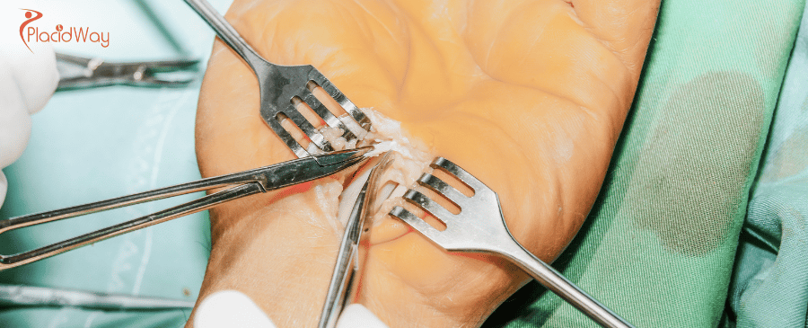 Affordable Carpal Tunnel Surgery in Turkey