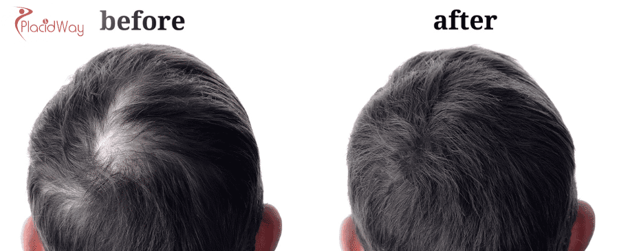 FUE Hair Transplant in Mexico 