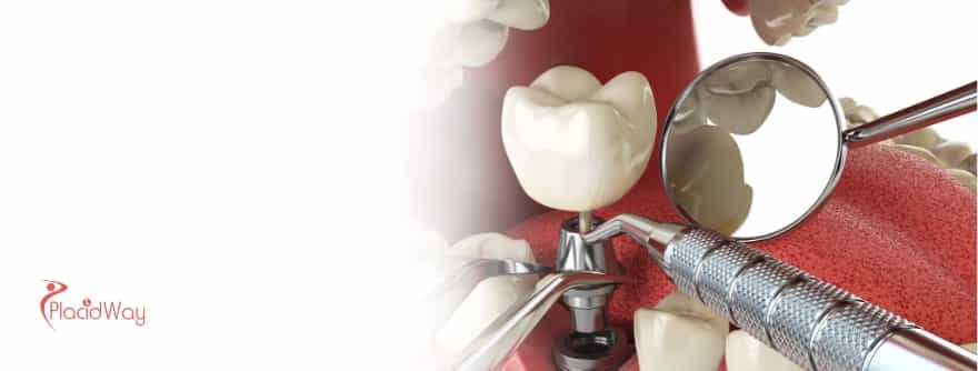 Illustration of the surgical placement of a dental implant
