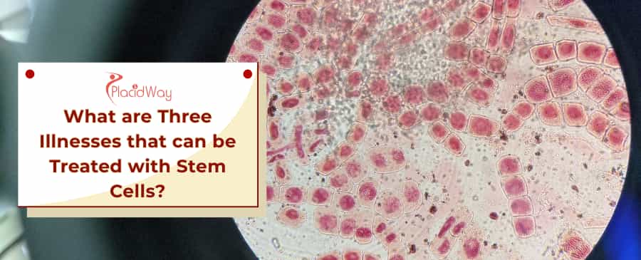 Stem Cell Treatment