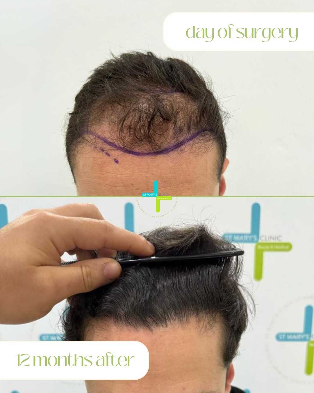 Antes y después del trasplante capilar en Malta