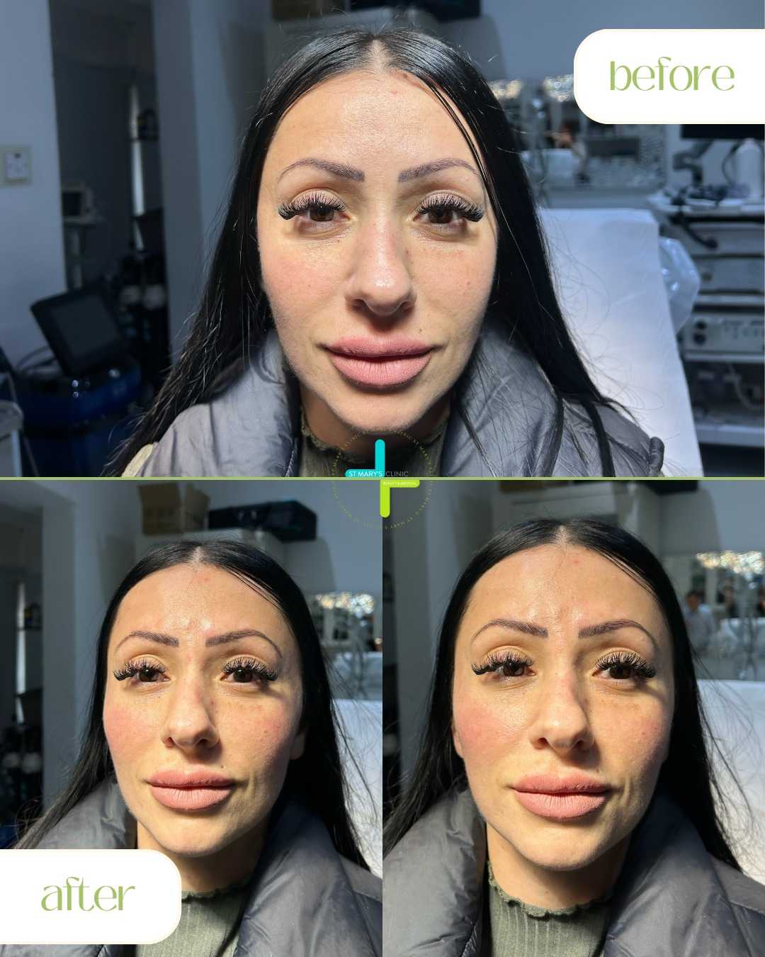 Antes y después de la rinoplastia en Malta