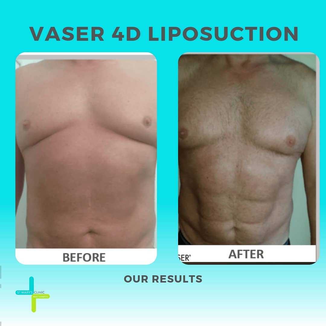 Antes y después de la liposucción Vaser en Malta