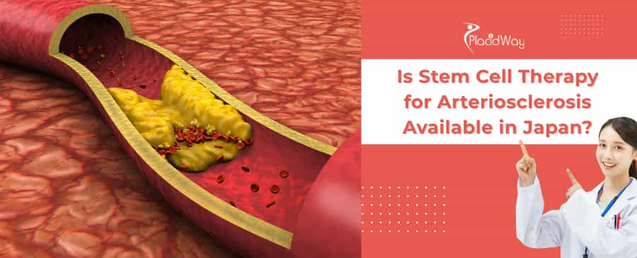 Stem Cell Therapy for Arteriosclerosis in Japan