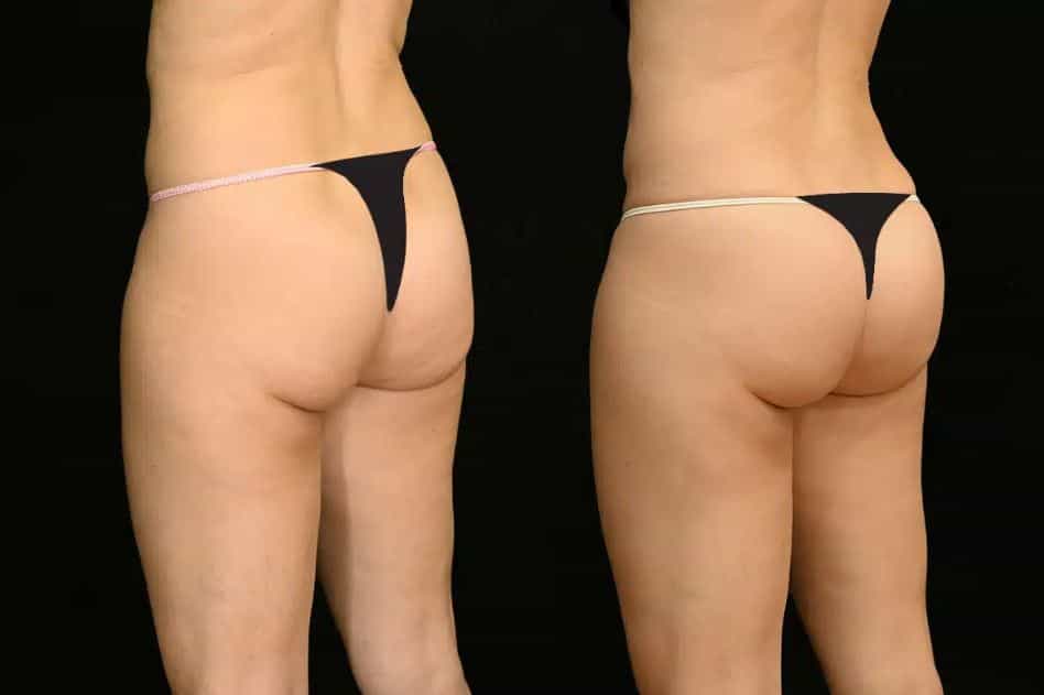 صور قبل وبعد علاج التثدي في اليونان