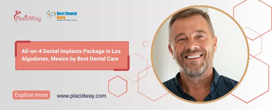 All on 4 Dental Implants in Los Algodones: Affordable Smile Solution