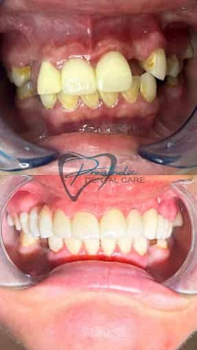 Antes Después Implantes Dentales en Los Algodones, México