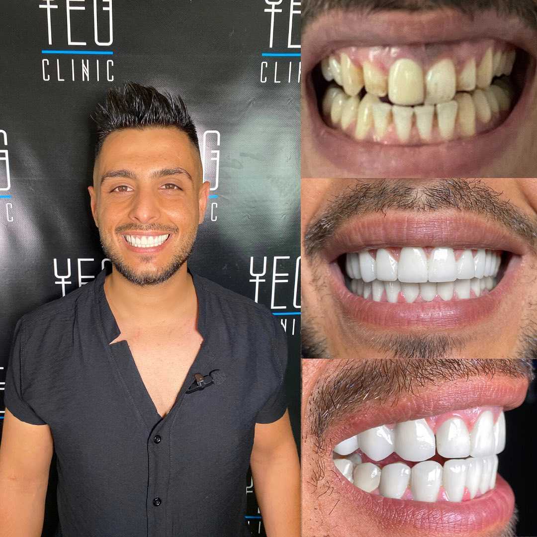 Imagen de antes y después de coronas de zirconio en Estambul, Turquía