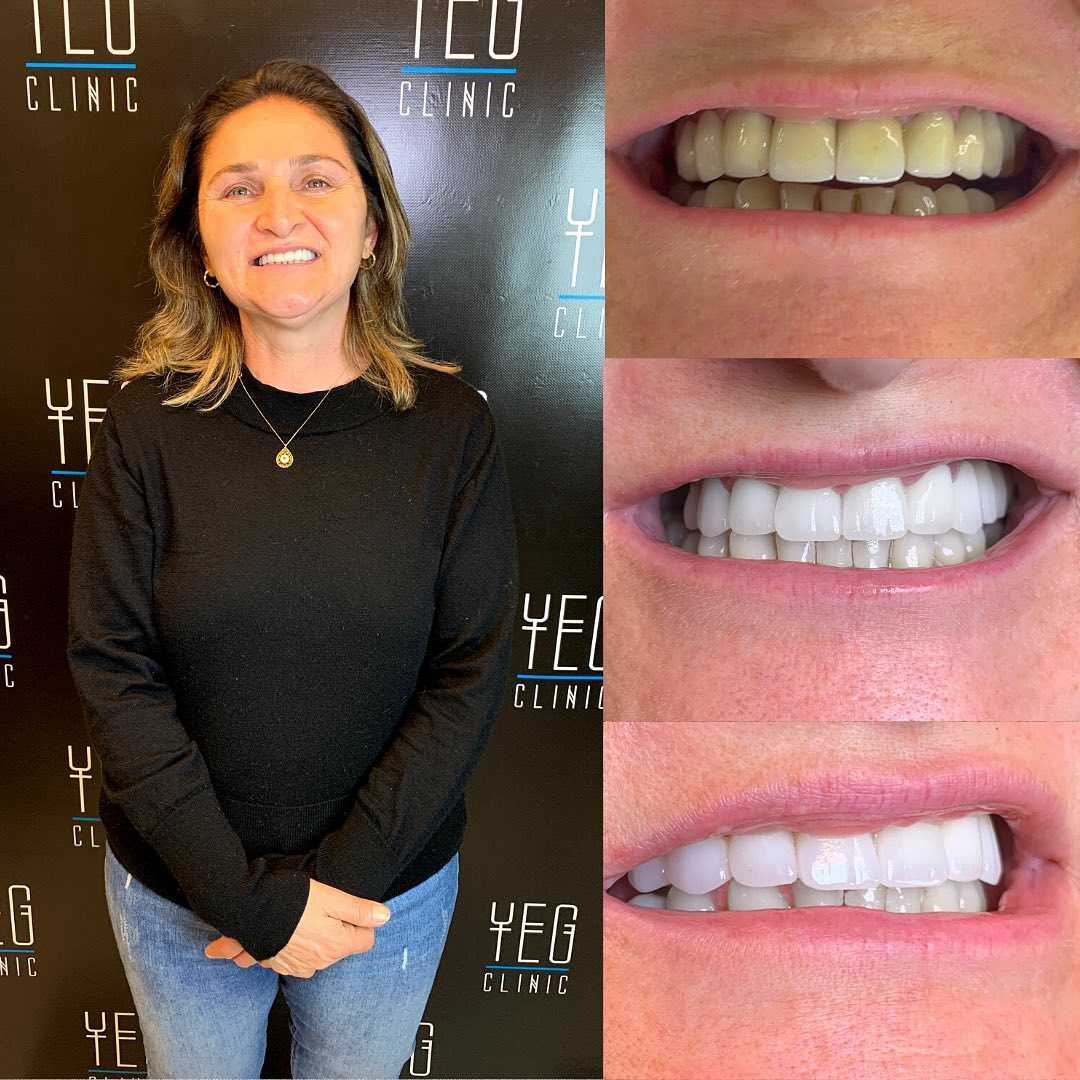 Imagen de antes y después de coronas de zirconio en Estambul, Turquía