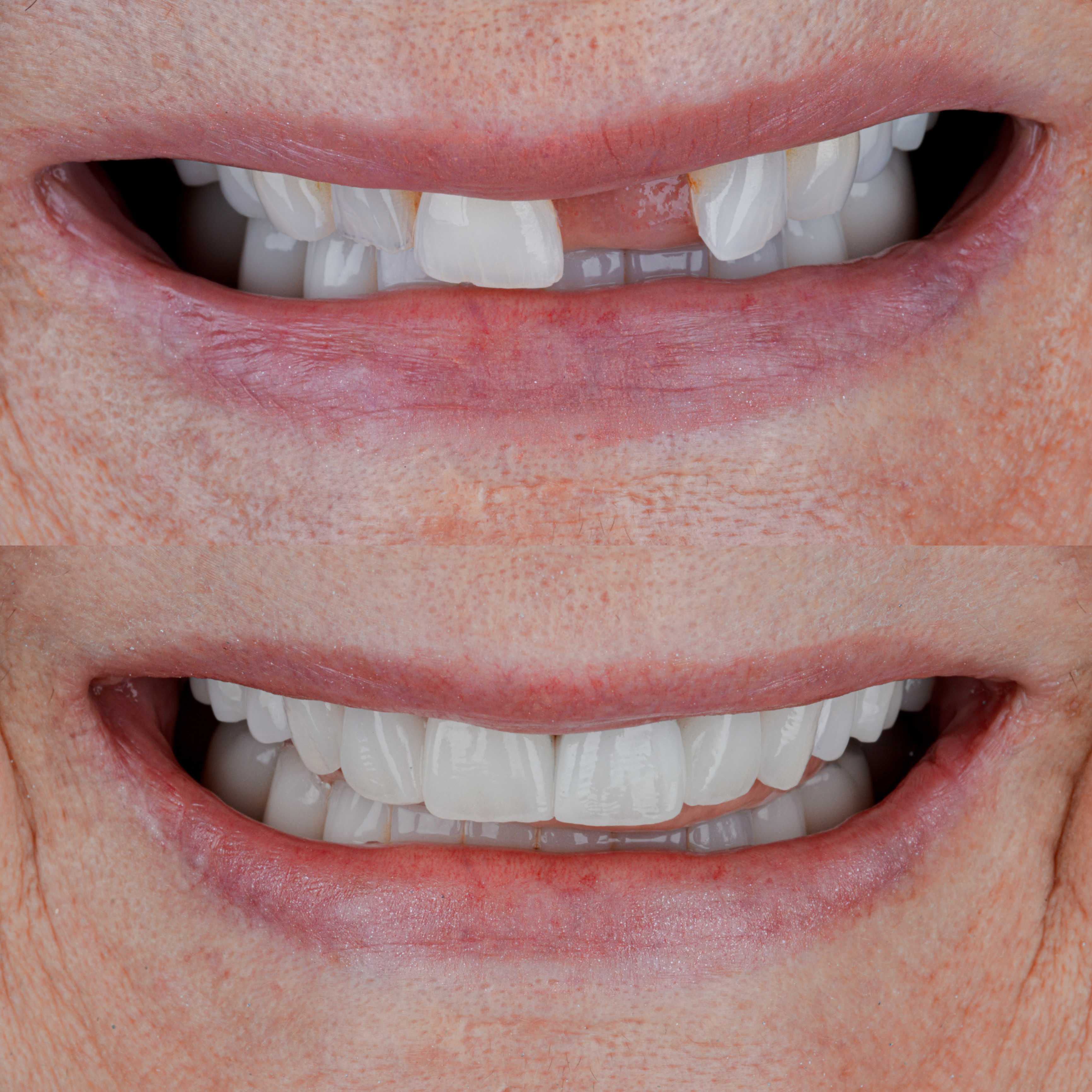 Before and After Smile Makeover in Los Algodones Mexico