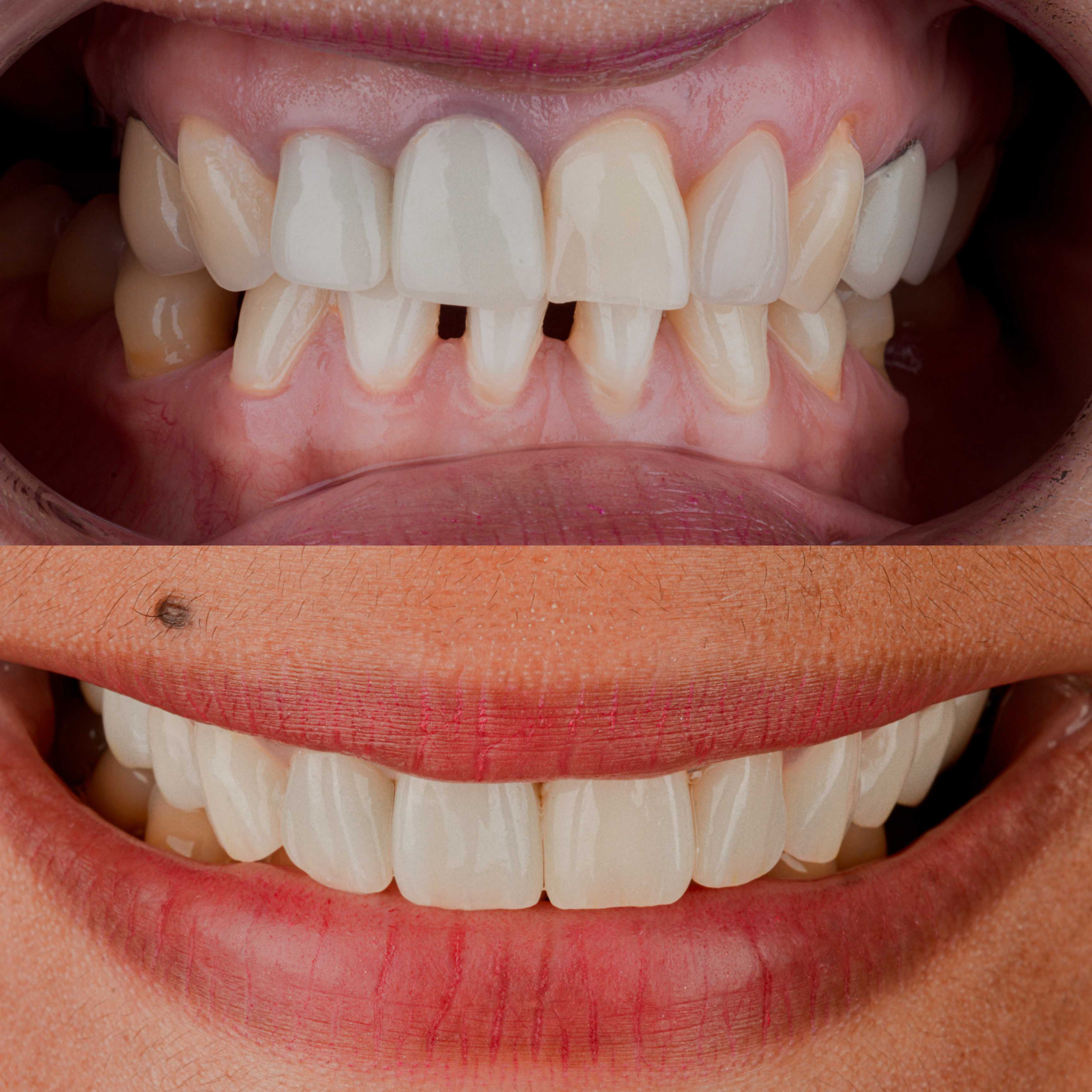 Before and After Smile Makeover in Los Algodones Mexico