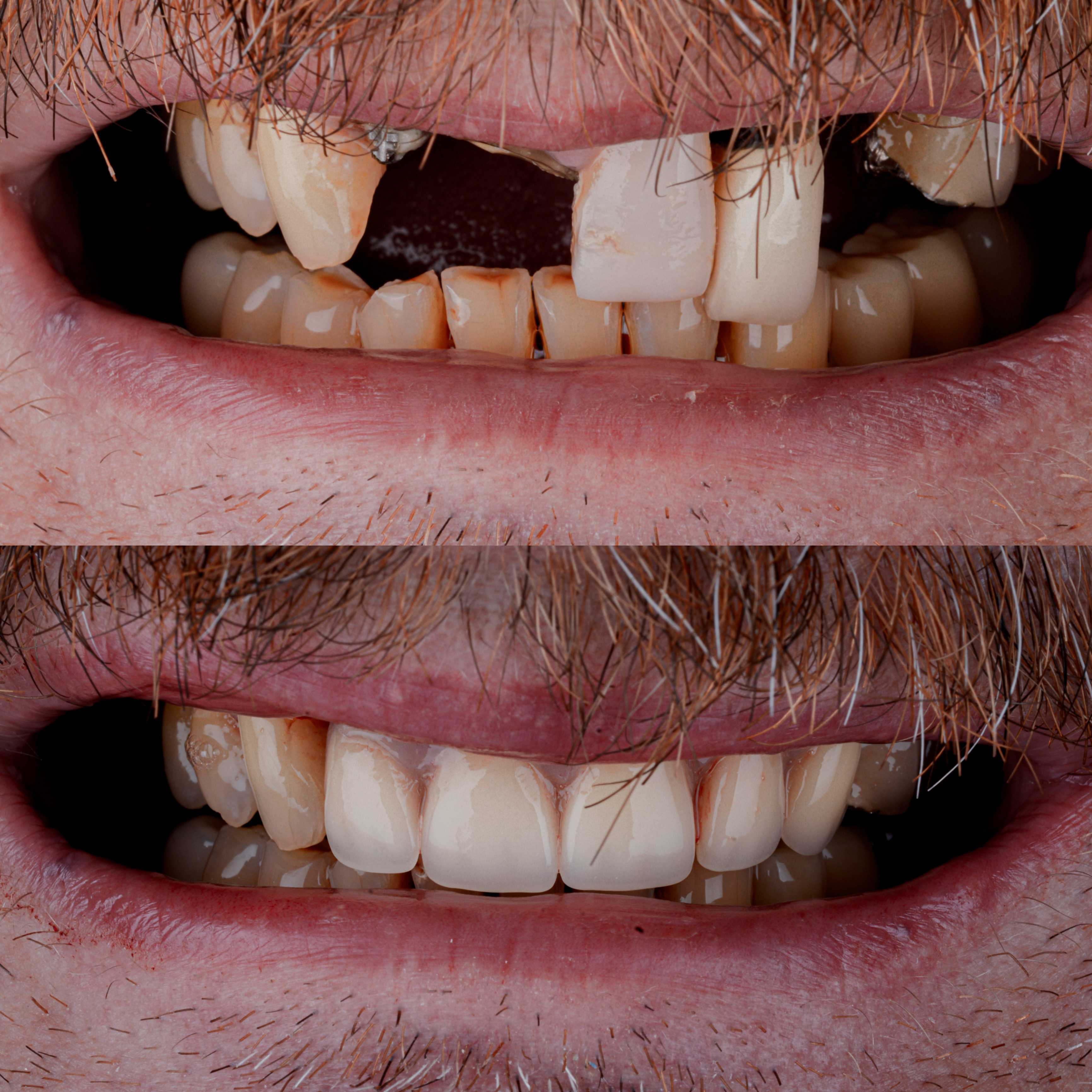 Before and After Full Mouth Restoration in Los Algodones Mexico