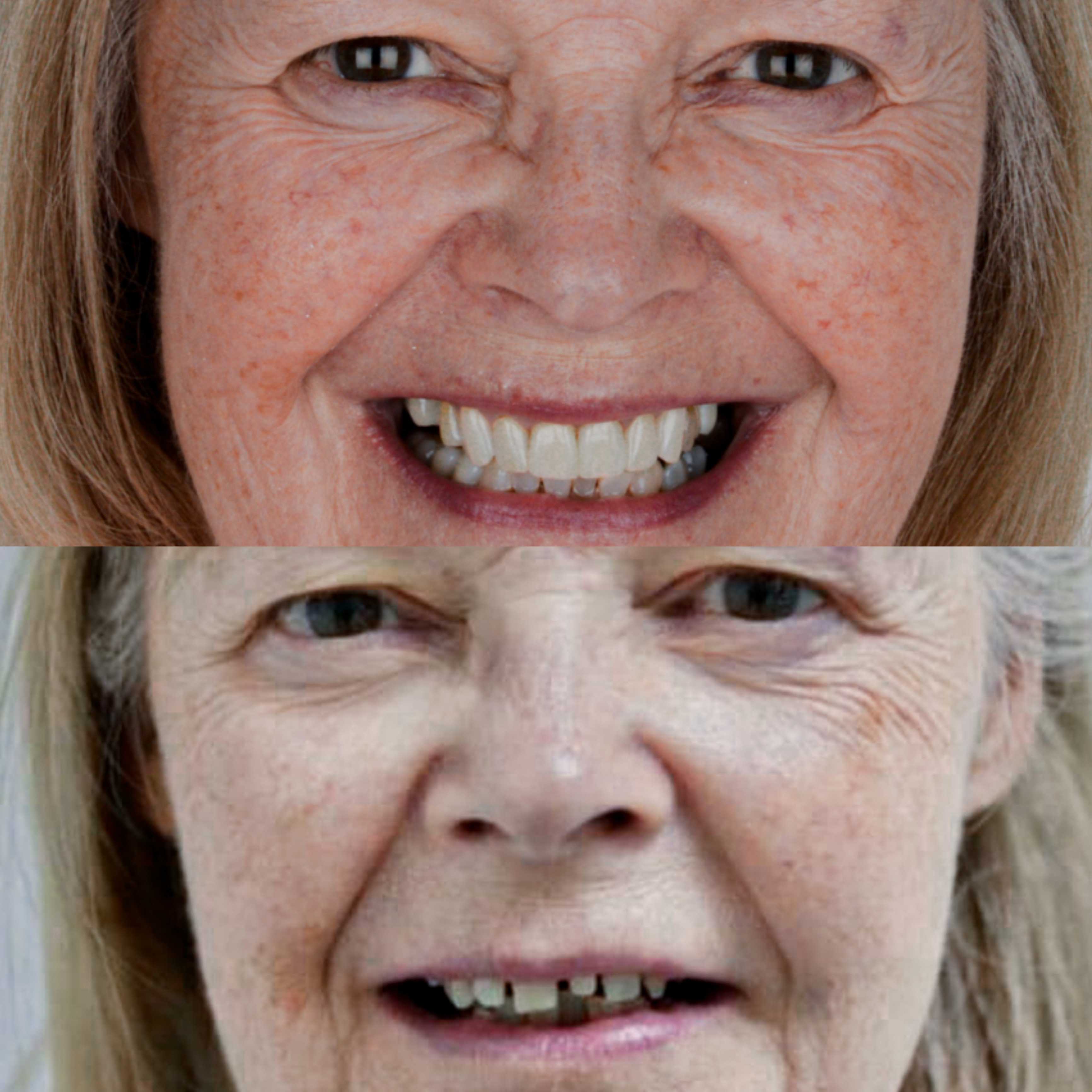 Before and After Smile Makeover in Los Algodones Mexico