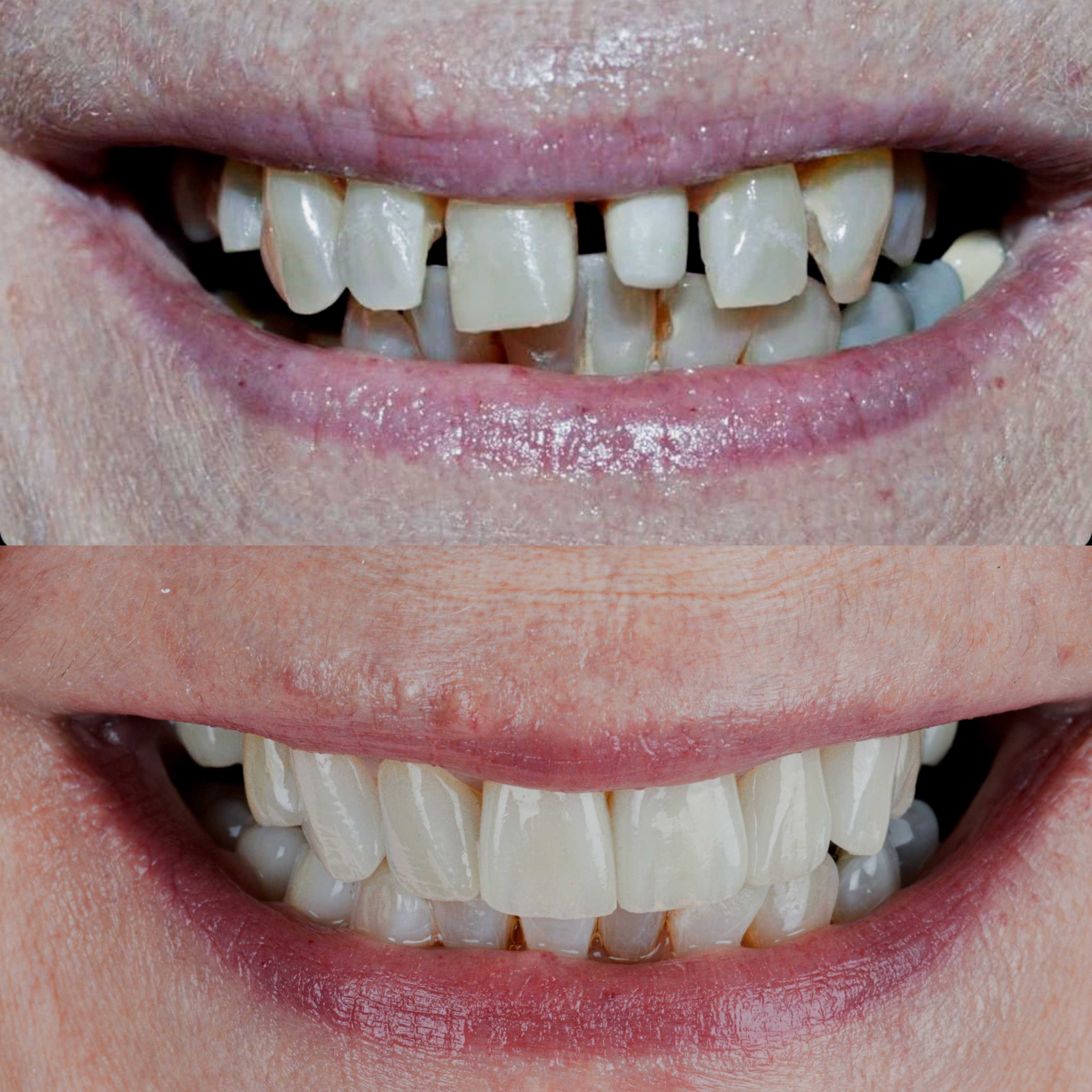 Before and After Smile Makeover in Los Algodones Mexico