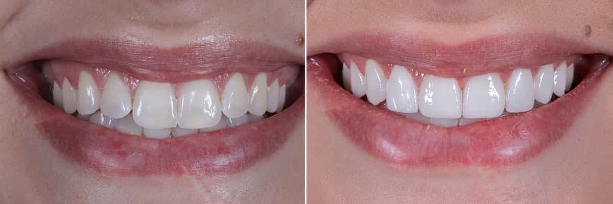 1-Sonrisa perfecta de Hollywood