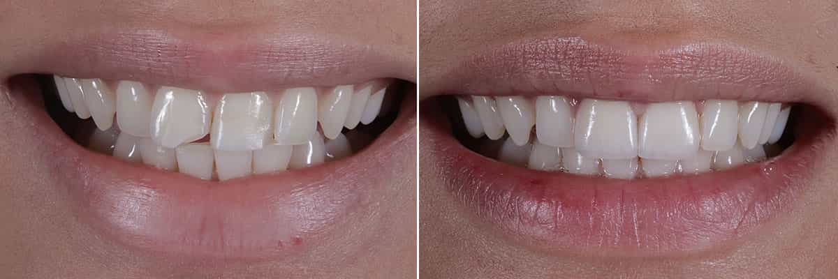 3-Dientes rotos arreglados con carillas