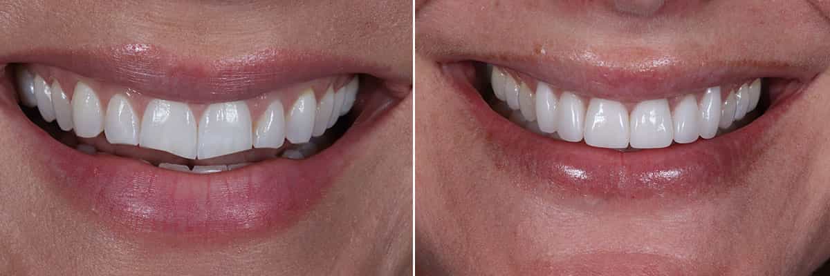 6-De dientes astillados a impecables con carillas