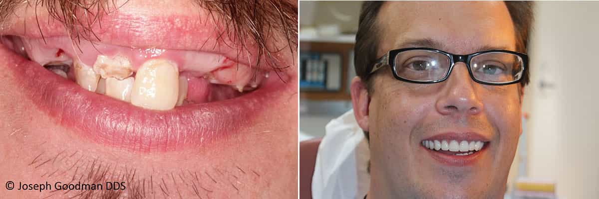 9-Remodelación de sonrisa con implantes, coronas y sobredentaduras