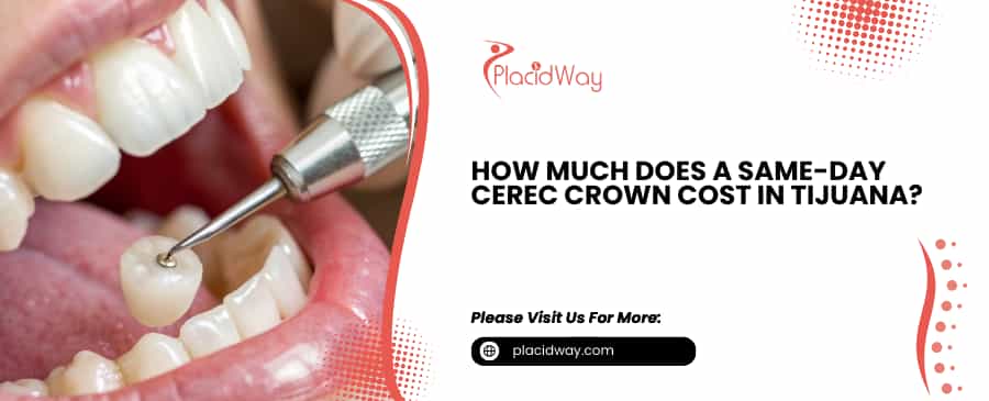Costo de la corona CEREC el mismo día en Tijuana