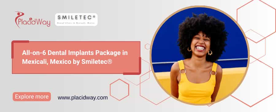 All-on-6 Dental Implants Package in Mexicali, Mexico by Smiletec®