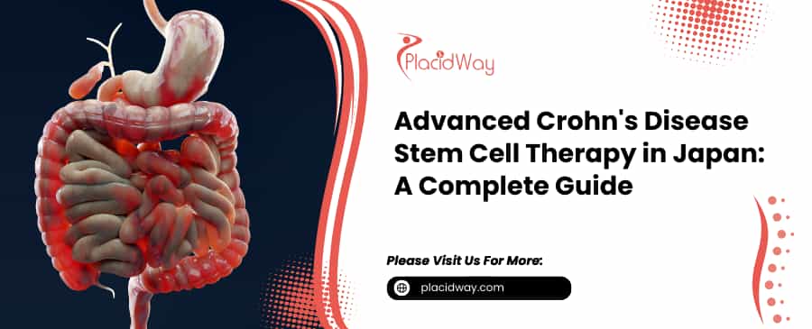 Crohns Disease Stem Cell Therapy in Japan