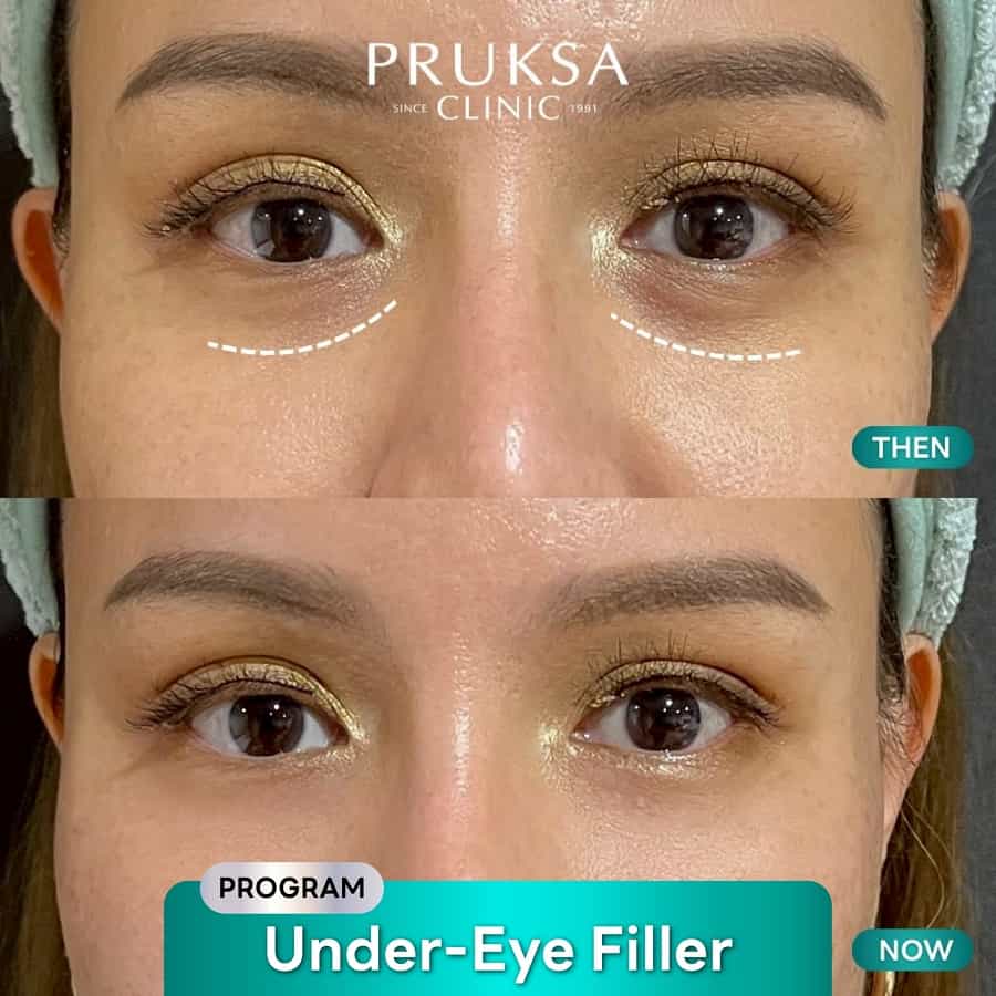 Under-Eye Filler – Primary Case