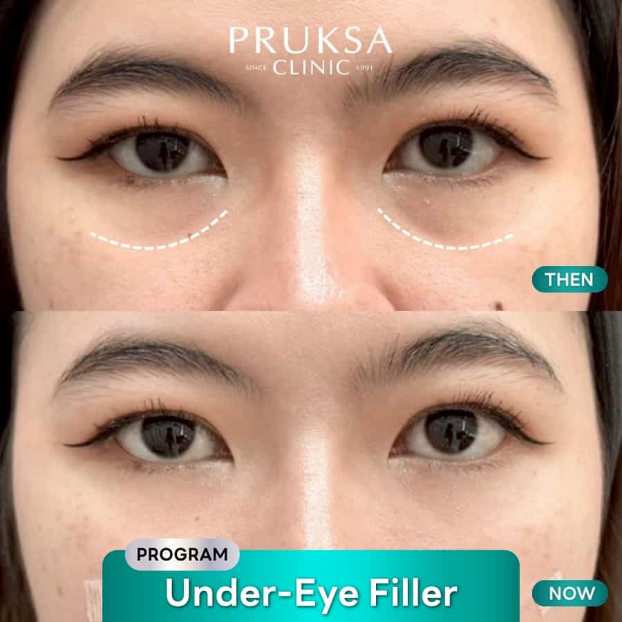 Under-Eye Filler – Supporting Case