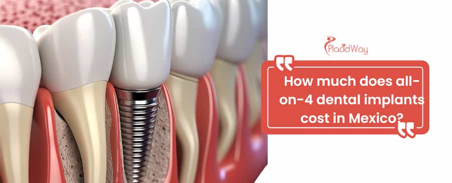 all-on-4 dental implants in Mexico
