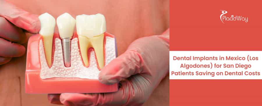 Dental Implants in Mexico (Los Algodones)