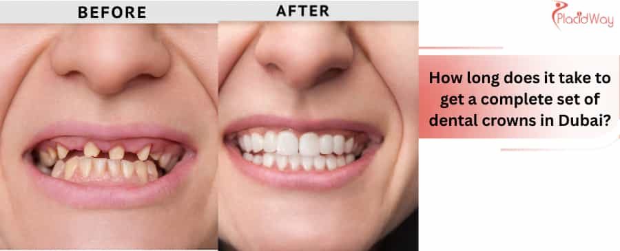 Dental Crowns in Dubai