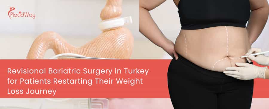 Cirugía bariátrica de revisión en Turquía para pacientes que reinician su proceso de pérdida de peso.