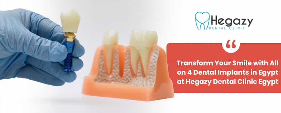dental implants in Egypt
