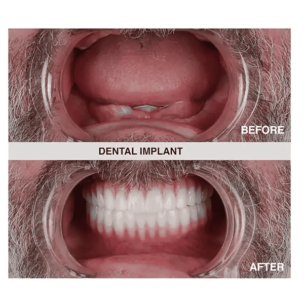 Antes y después de los implantes dentales en Estambul, Turquía