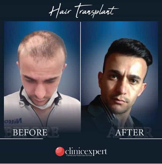 Antes y después del trasplante capilar en Estambul, Turquía