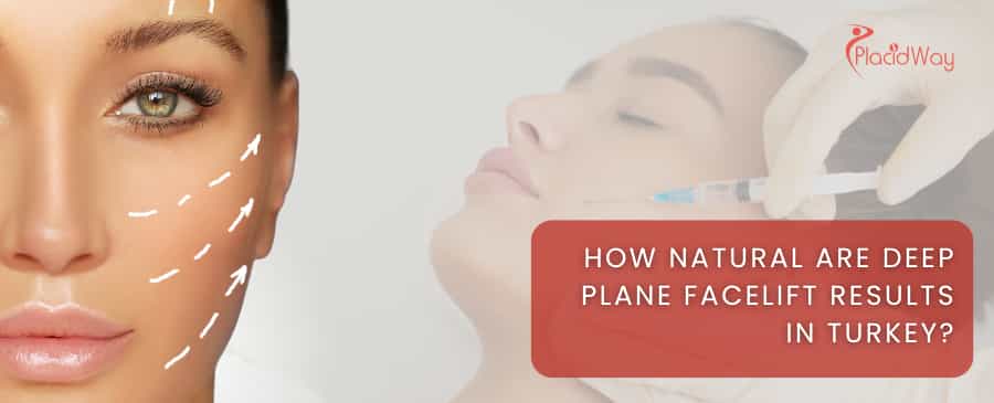 How natural are deep plane facelift results in Turkey?