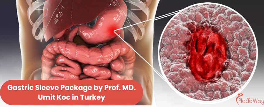 Gastric Sleeve Package by Prof. MD. Umit Koc in Turkey