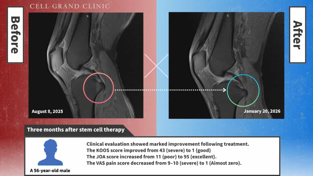 صور قبل وبعد: علاج الركبة بالخلايا الجذعية في اليابان