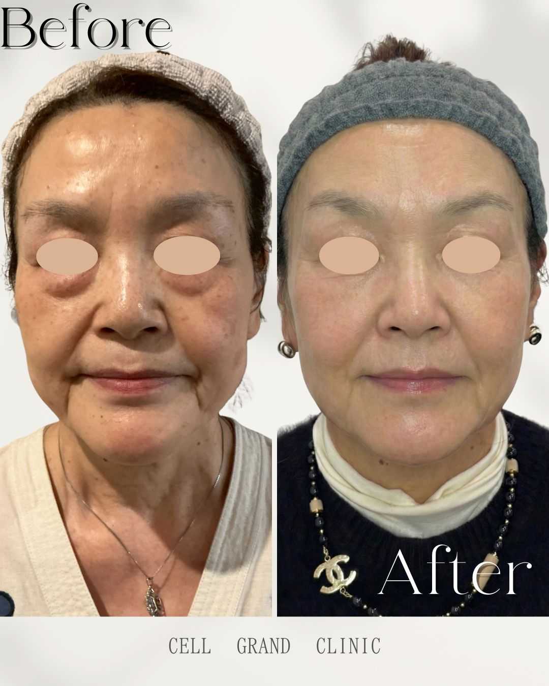 صور قبل وبعد: علاج الخلايا الجذعية للنساء في الثلاثينيات من العمر باستخدام الخلايا الليفية في اليابان