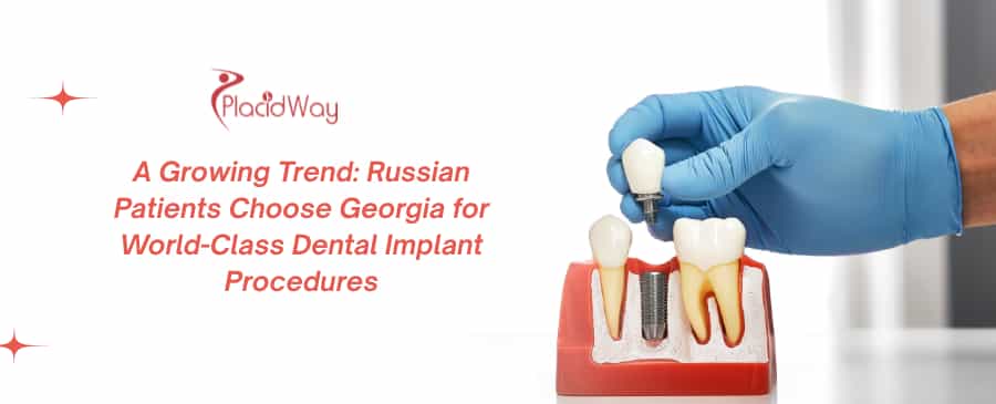 A Growing Trend: Russian Patients Choose Georgia for World-Class Dental Implant Procedures