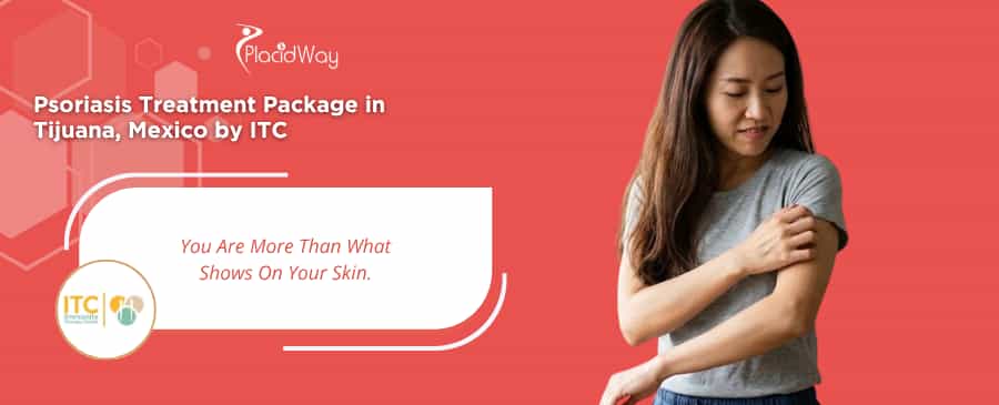 Psoriasis Treatment in Tijuana