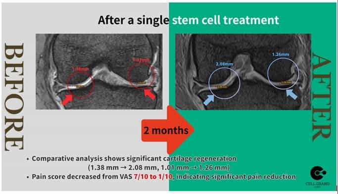 Before After Stem Cell in Japan
