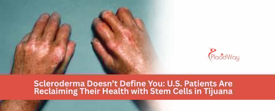 Scleroderma Doesn’t Define You: U.S. Patients Are Reclaiming Their Health with Stem Cells in Tijuana