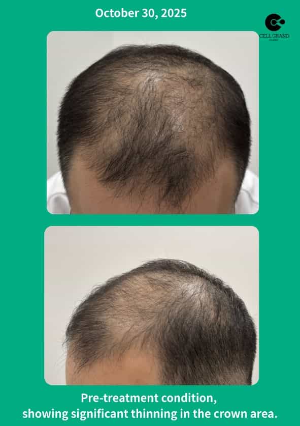stem cell therapy for hair loss in Japan before after image