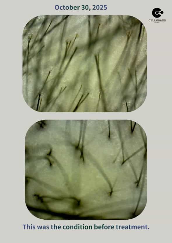 stem cell therapy for hair loss in Japan before after picture