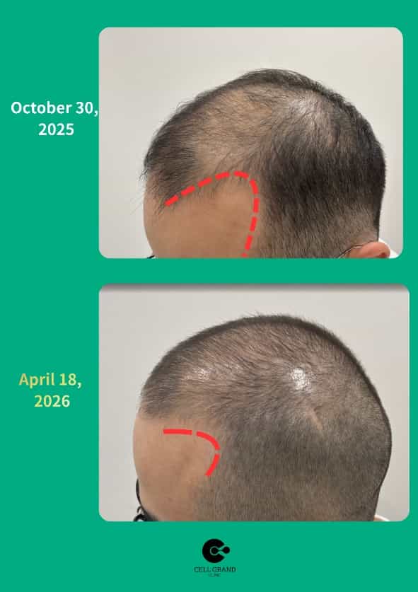 After Condition Buzzed