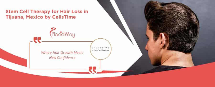 Stem Cell Therapy for Hair Loss in Tijuana Mexico at CellsTime Clinique